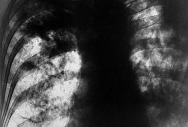 Coal Mines Make Black Lung