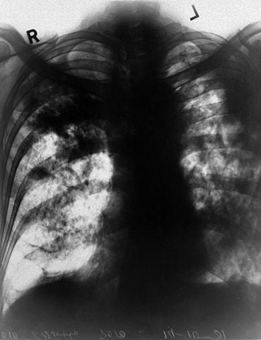 Coal Mines Make Black Lung